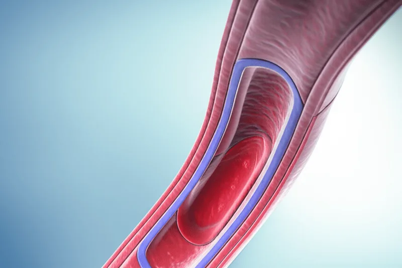 Apa pembuluh getihmu kenthel? Ayo goleki apa sejatine arteriosklerosis kuwi!