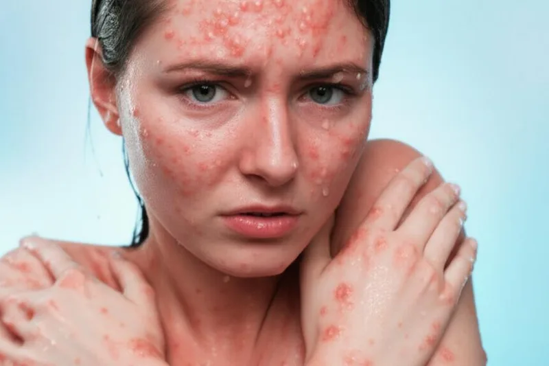 Naha cai nyababkeun ateul? Naha nyeri? Hayu urang diajar ngeunaan alergi langka ieu (Aquagenic Urticaria)