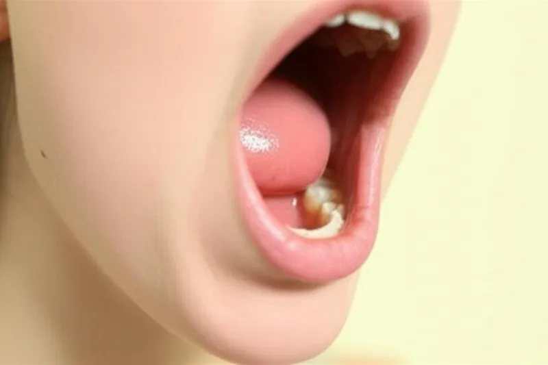 Tonsil (Da kɔnɔna farikolow) Banaw: A Makari, A Dɔnko Ani A Furakɛcogo