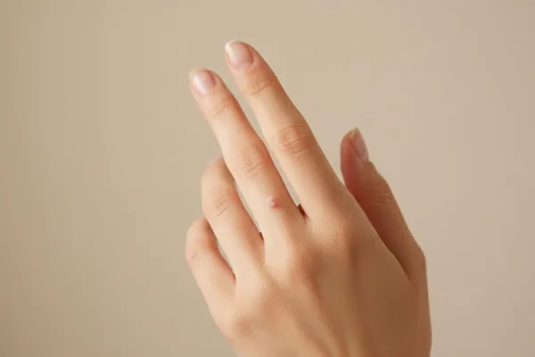 Tes verrugas tamén? Aprendamos todo sobre elas!