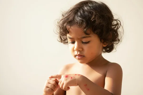 ඔයාගේ දරුවටත් මේ වගේ කසන බිබිලි එනවද? අපි (Poison Ivy) ගැන කතා කරමු!