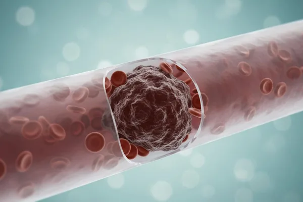 Ka tuyige mu ngeri ennyangu ku Thrombectomy, okulongoosa okuggyawo ekizimba ky’omusaayi ekikwatiddwa mu musuwa?