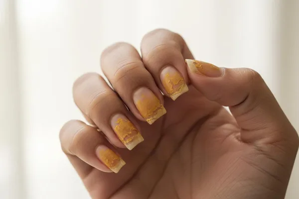 ጽፍርኻ ጽዩፍን ሕብሩ ተቐይሩን ድዩ? እዚ (Dystrophic Nails) ይበሃል - ብዛዕባ እዚ ንዛረብ!