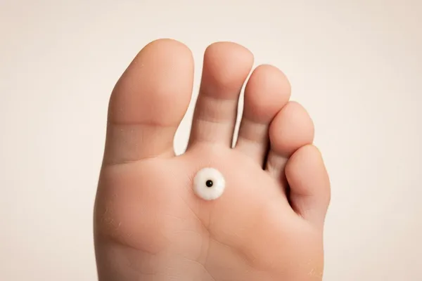 您聽過「沙蚤病」嗎?這是一種由沙蚤引起的惱人皮膚病。我們來聊聊吧!