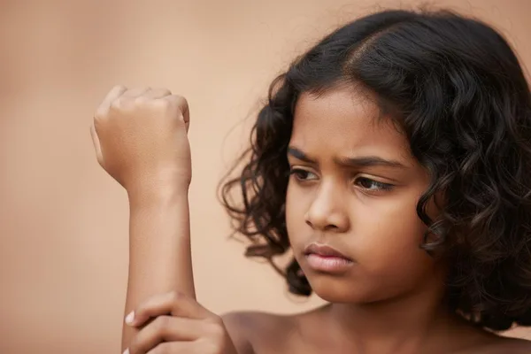 Akpụkpọ ahụ nwa gị ọ̀ na-eme ka ọ sie ike ma na-agbaze? Ka anyị kwuo maka ọrịa Scleroderma nke ụmụaka!