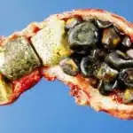 Gallbladder & Gallstones Meaning in Sinhala: පිත්තාශය (Gallbladder) සහ පිත්තාශයේ ගල් (Gallstones) ගැන හැමදේම දැනගමු!