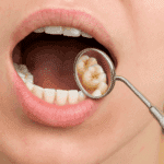 ඥාන දත / ප්‍රඥා දත් (Wisdom Teeth) කියන්නේ මොකක්ද? කැක්කුමට හේතු සහ ප්‍රතිකාර
