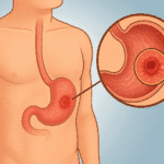 බඩේ තුවාල (Stomach Ulcer / Gastric Ulcer) කියන්නේ මොකක්ද? ආමාශයේ තුවාල, බඩේ දැවිල්ල සහ නිවැරදි ප්‍රතිකාර ගැන දැනගමු