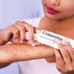 كريم كروتاميتون (Crotamiton) للجرب والحكة: دليلك الشامل للاستخدام والآثار الجانبية