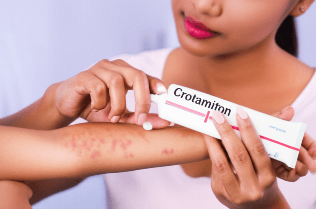 හොරි (Scabies) නිසා දරාගන්න බැරිව කසනවද? Crotamiton ක්රීම් එක ගැන දැනගමු!