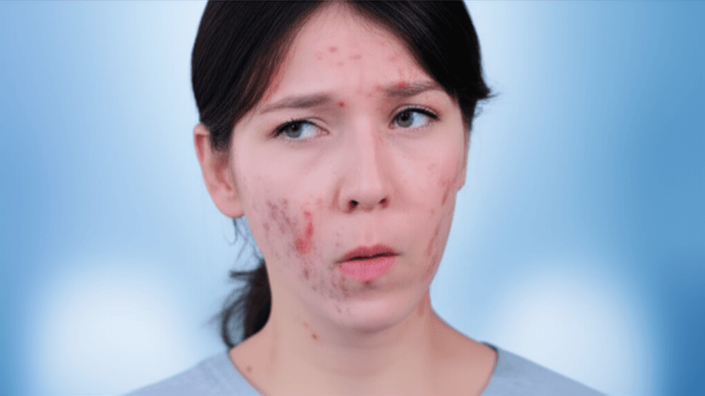 ඔයාගේ ලේ වල මේ අමුතු ප්‍රෝටීන ගැන අහල තියෙනවද? (Cryoglobulinemia) අපි මේ ගැන කතා කරමු!