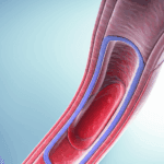 ලේ නහර ඝන වීම සහ අවහිර වීම (Arteriosclerosis & Atherosclerosis) කියන්නේ මොකක්ද? රෝග ලක්ෂණ සහ ප්‍රතිකාර