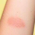 Clotrimazole Cream Uses in Sinhala: සමේ දිලීර ආසාදන (අළුහම්, ඉකිලි කැසීම) සුව කරන ක්ලෝට්‍රිමසෝල් ආලේපනය ගැන හරියටම දැනගමු