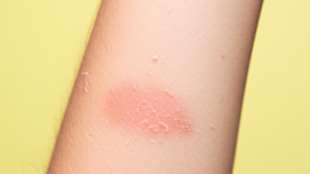 හමේ හැදෙන දිලීර ආසාදනවලට විසඳුමක්: Clotrimazole (ක්ලෝට්‍රිමසෝල්) ගැන හරියටම දැනගමු