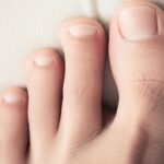 हैमरटो (Hammertoe) क्या है? पैर की मुड़ी उंगली के कारण, लक्षण और घरेलू-मेडिकल उपचार