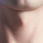වසා ගැටිති හෙවත් කුද්දැටි (Lymph Nodes) කියන්නේ මොනවද? ඉදිමෙන්නේ ඇයි සහ ප්‍රතිකාර (Lymph Nodes Meaning in Sinhala)