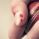 شکستگی کنده شدن یا اوالژن (Avulsion Fracture) چیست؟ علائم، درمان و پیشگیری