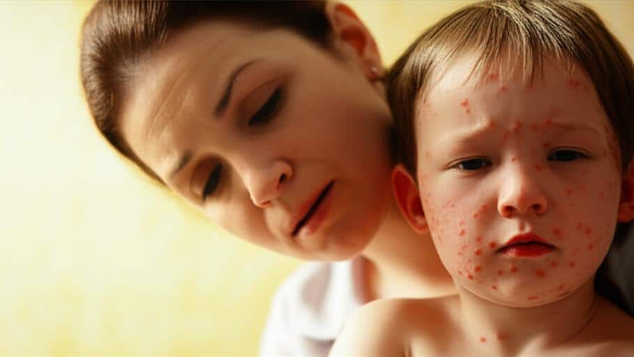 Have you also got chickenpox? Don't worry! Let's learn everything about chickenpox