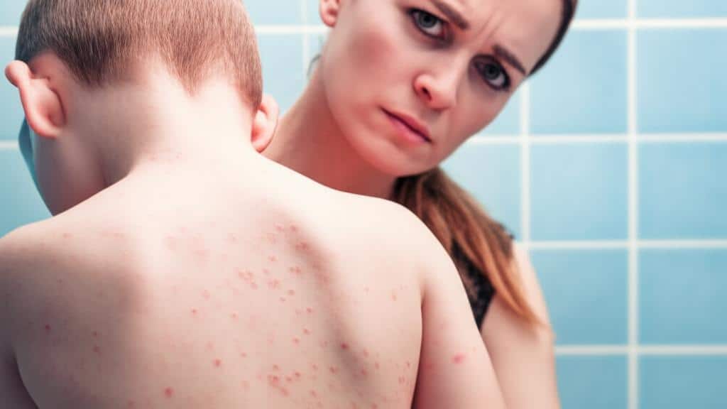 Do you get blisters after swimming in the pool? It could be Hot Tub Folliculitis!