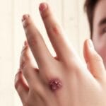 Is Your Wound Scabbing Over? Discover What Your Scab Is Trying to Tell You