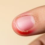 नाखून के पास सूजन, दर्द और मवाद? पैरोनिकिया (Paronychia) के लक्षण, कारण और घरेलू इलाज