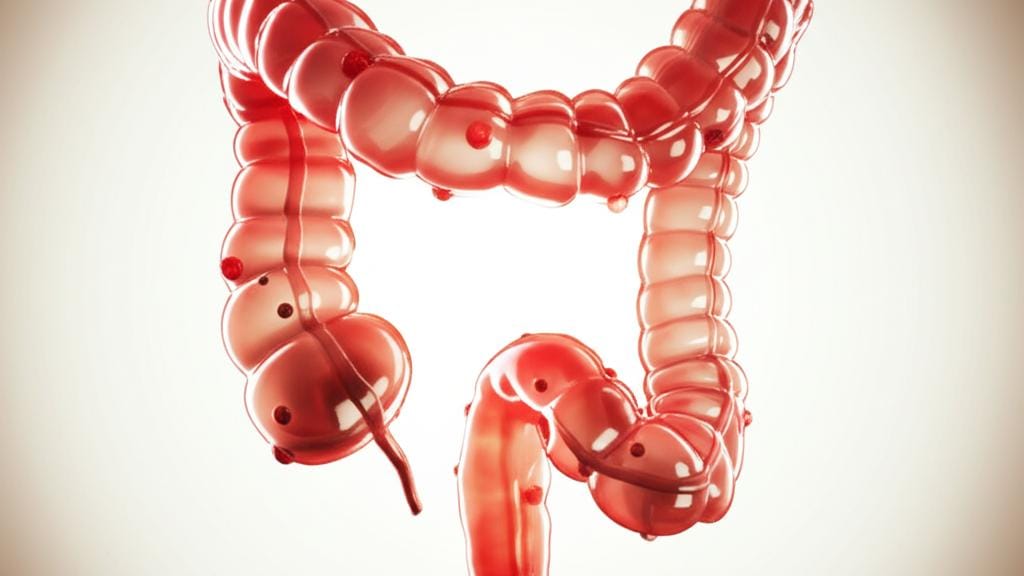 ඔයාගේ මහා බඩවැලේ පොඩි ගෙඩි (Colon Polyps) ගැන දැනගමුද? බය වෙන්න එපා, අපි කතා කරමු!