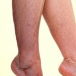 Dermatite de stase veineuse : causes, symptômes, traitements et conseils pratiques pour vos jambes