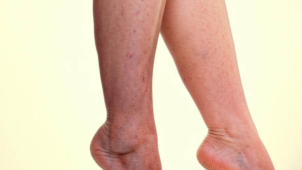 ඔයාගේ කකුල් ඉදිමිලා, හම වෙනස් වෙලාද? මේ සමහරවිට (Venous Stasis Dermatitis) වෙන්න පුළුවන්!