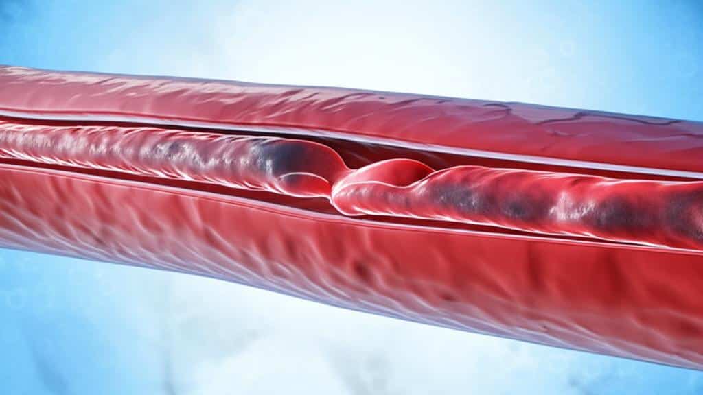 ඔයාගේ රුධිර නාල වලටත් හානි වෙන්න පුළුවන්ද? අපි කතා කරමු ෆයිබ්රිනොයිඩ් නෙක්රෝසිස් (Fibrinoid Necrosis) ගැන!