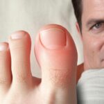 Hallux Limitus (ограничение подвижности большого пальца стопы): причины, симптомы и лечение