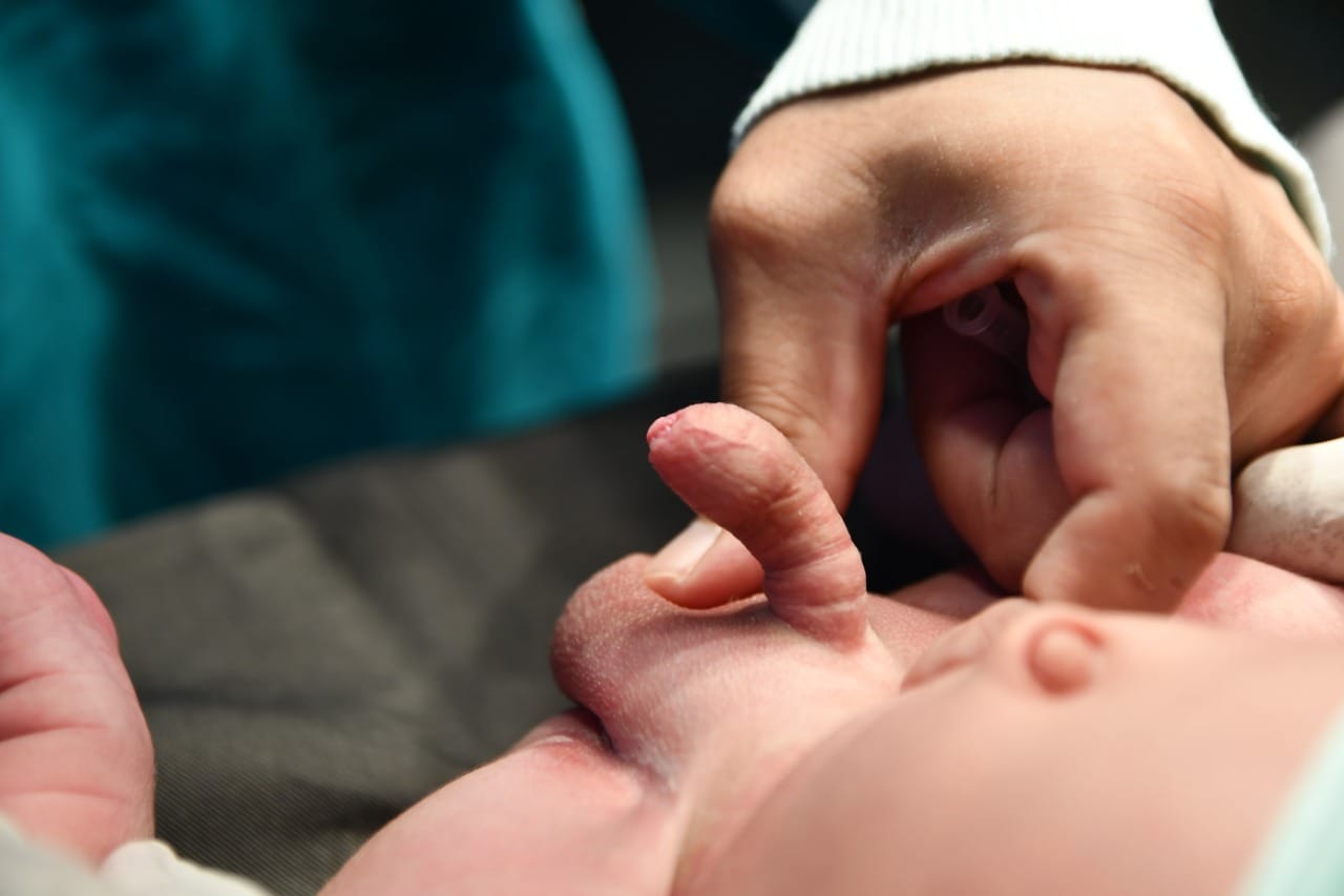 ඔයාගේ පොඩි පුතාගේ ලිංගය ඇද වෙලා වගේද මේ කියන්නේ (Penile Torsion) ගැනද අපි කතා කරමු!