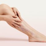 Vai arī jums ir varikozas vēnas un sāp kājas? Vēnu slimības un mūsdienu ārstēšanas metodes