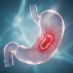 බඩේ තුවාල (Ulcer) වලට දෙන Sucralfate දියරය ගැන හරියටම දැනගමු (Sucralfate Suspension)